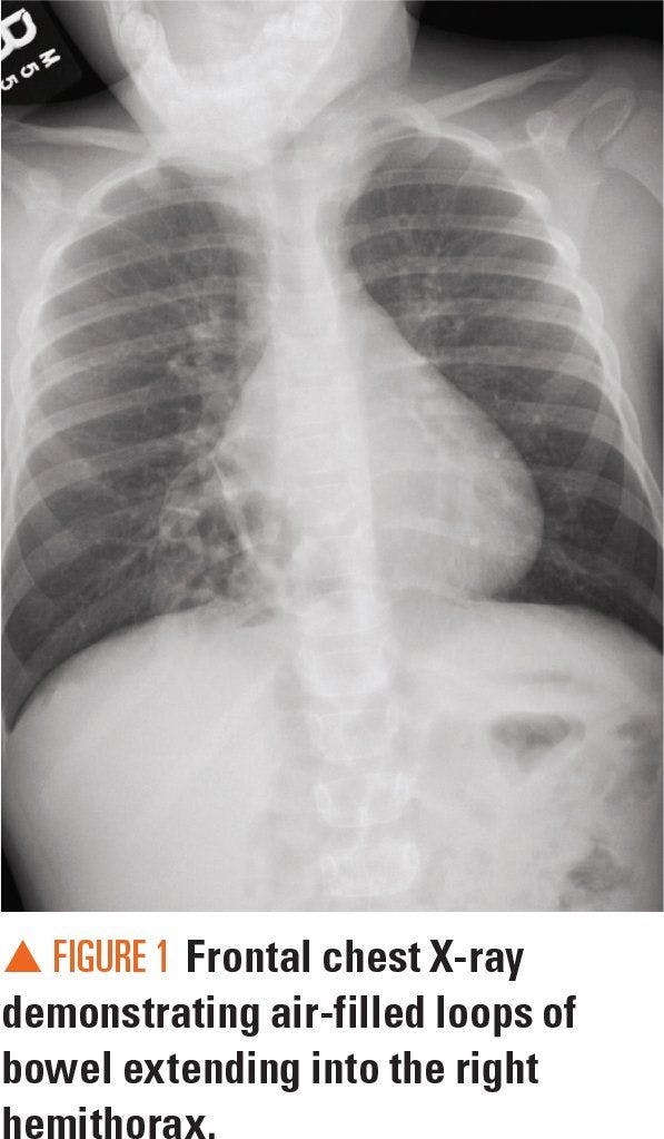 Frontal chest X-ray demonstrating air-filled loops of bowel extending into the right hemithorax.