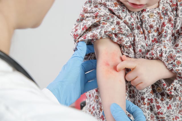 Study lays groundwork for potential vaccine customized for children with recurrent eczema flares | Image Credit: © triocean - © triocean - stock.adobe.com.