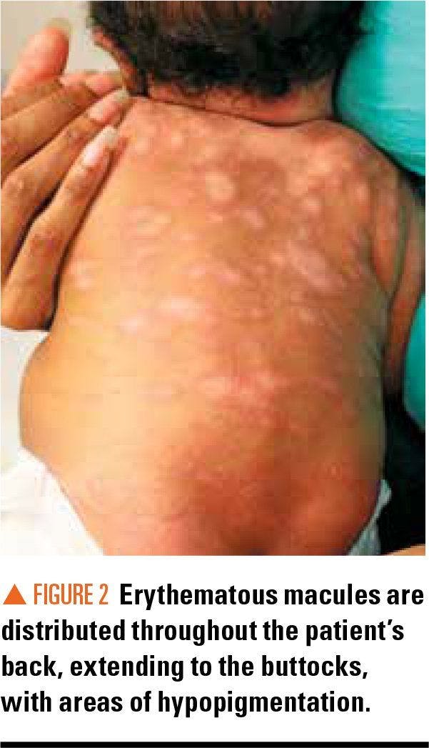 Erythematous macules on patients back with areas of hypopigmentation