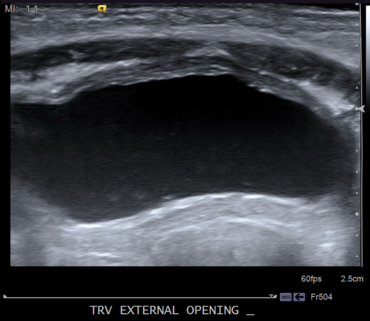 Transverse ultrasound image