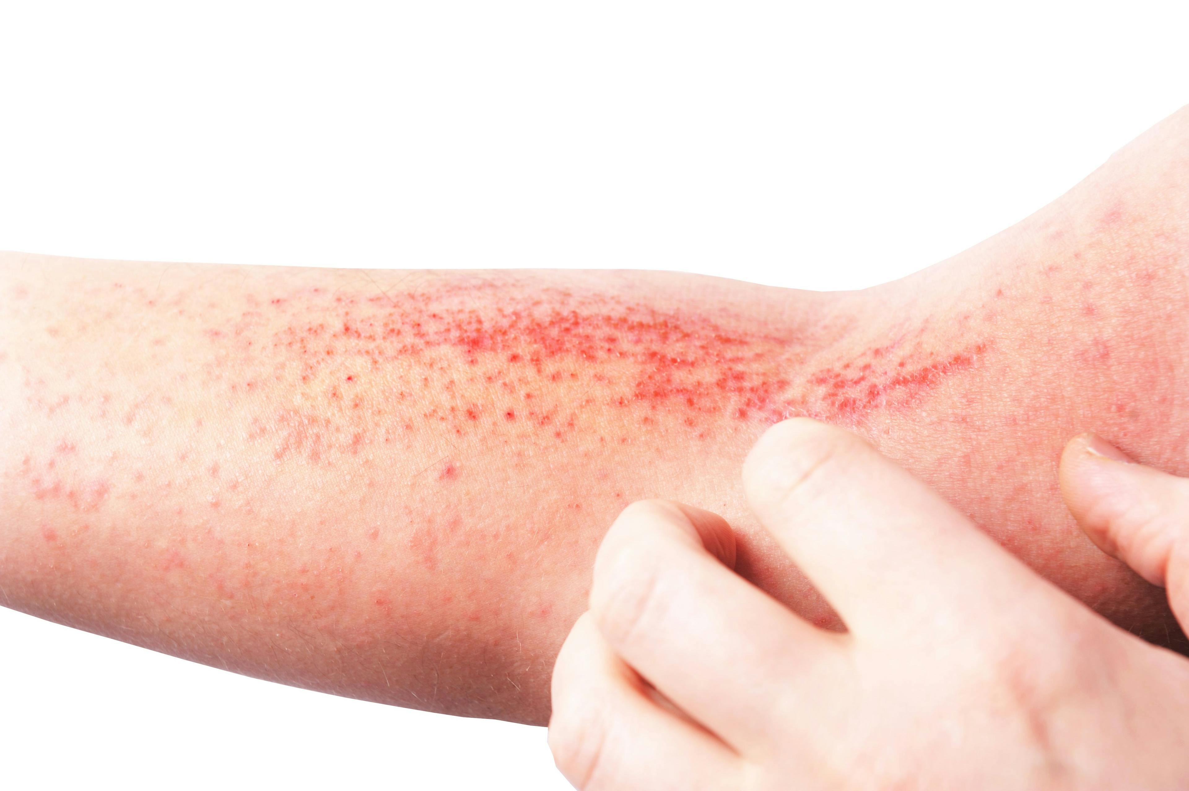 Stigmatization of chronic skin disorders plays role in children's quality of life | Image Credit: © lial88 - © lial88 - stock.adobe.com.
