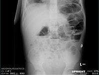 DISTAL INTESTINAL OBSTRUCTION SYNDROME