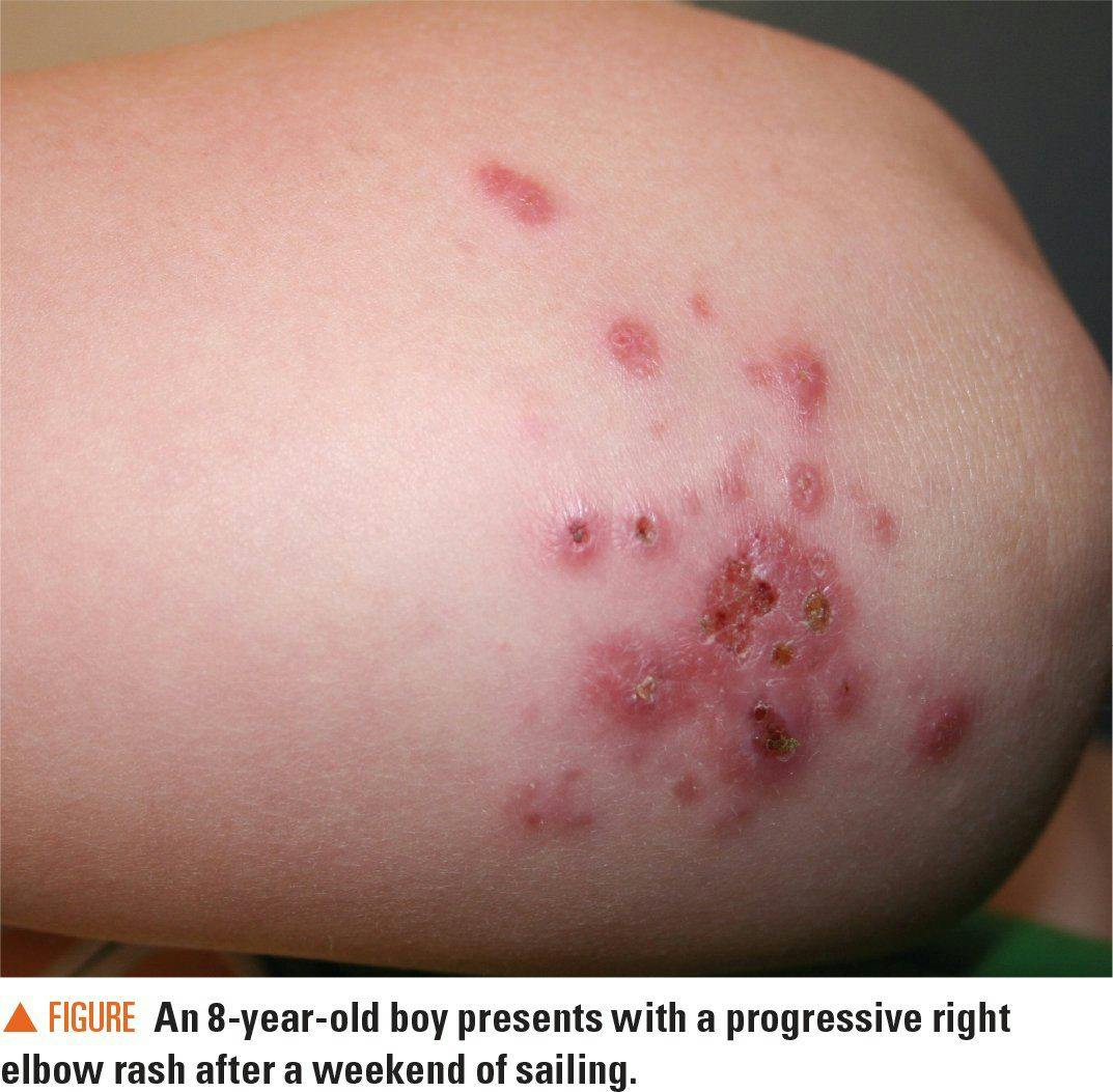 Image of boy's progressive right elbow rash
