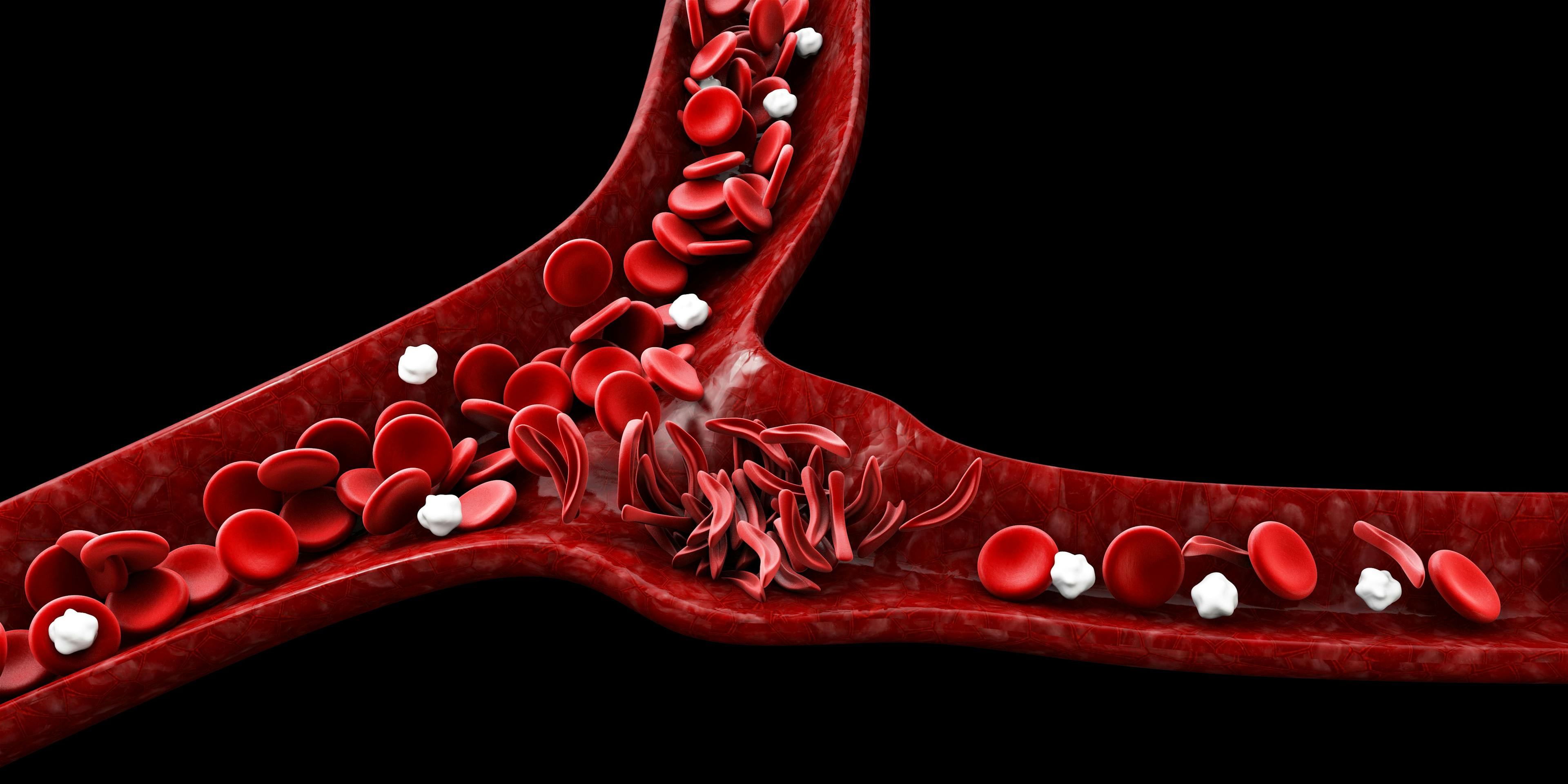 Improved sickle cell disease in children associated with hydroxyurea treatment | Image Credit: © tussik - © tussik - stock.adobe.com.