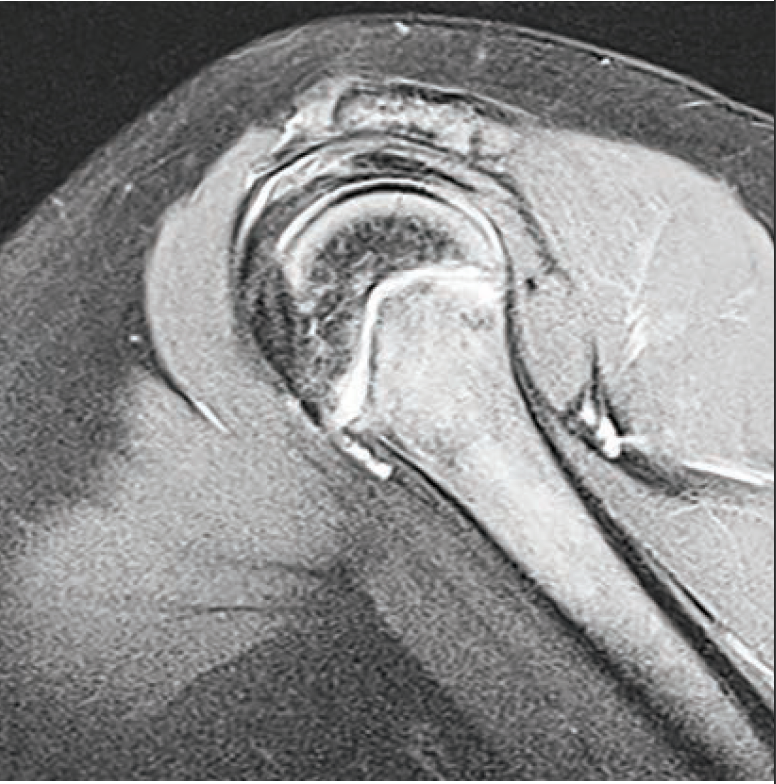 MRI image of the shoulder