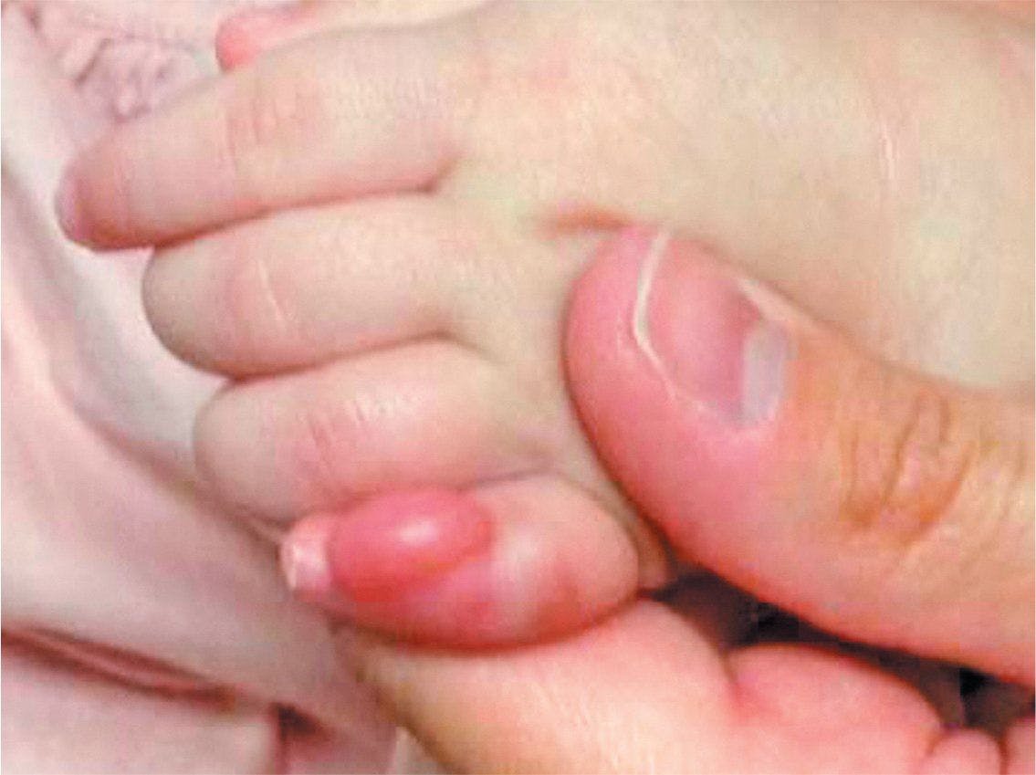 image of infant with infantile digital fibroma