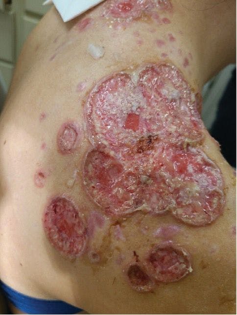 Figure 2. Ulcerated lesions with some necrosis present. (Image provided by author)