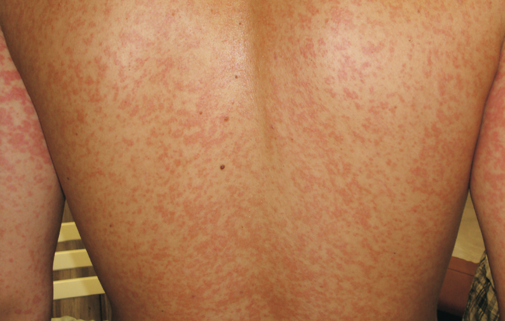 Teenager with sudden diffuse dermatitis