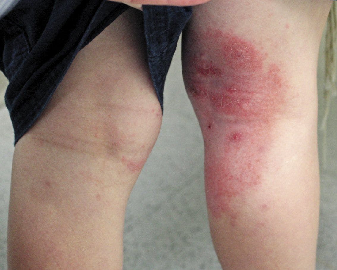A red itchy rash developed on the patient's right leg