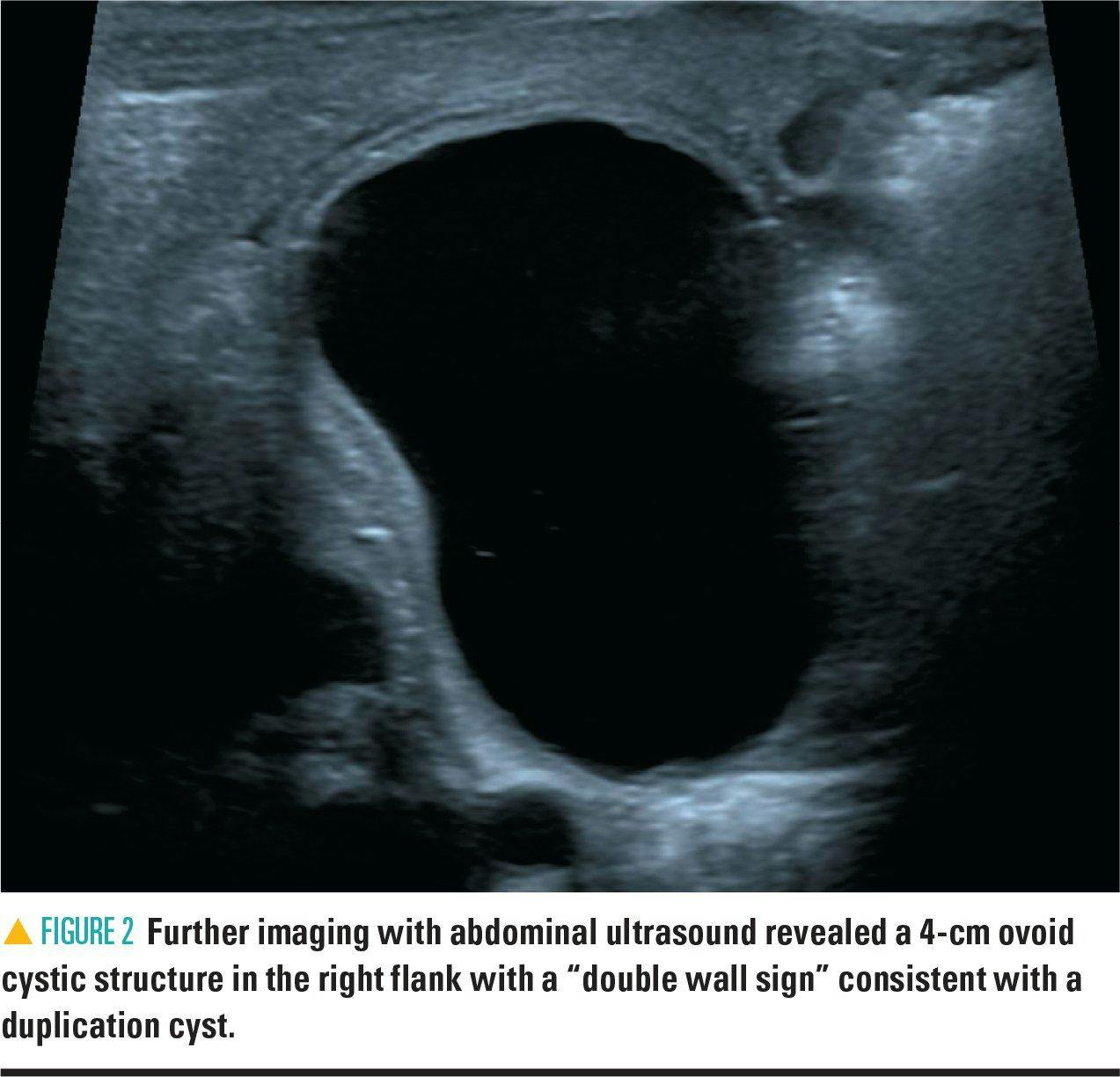 further imaging showing 'double wall sign' consistent with a duplication cyst