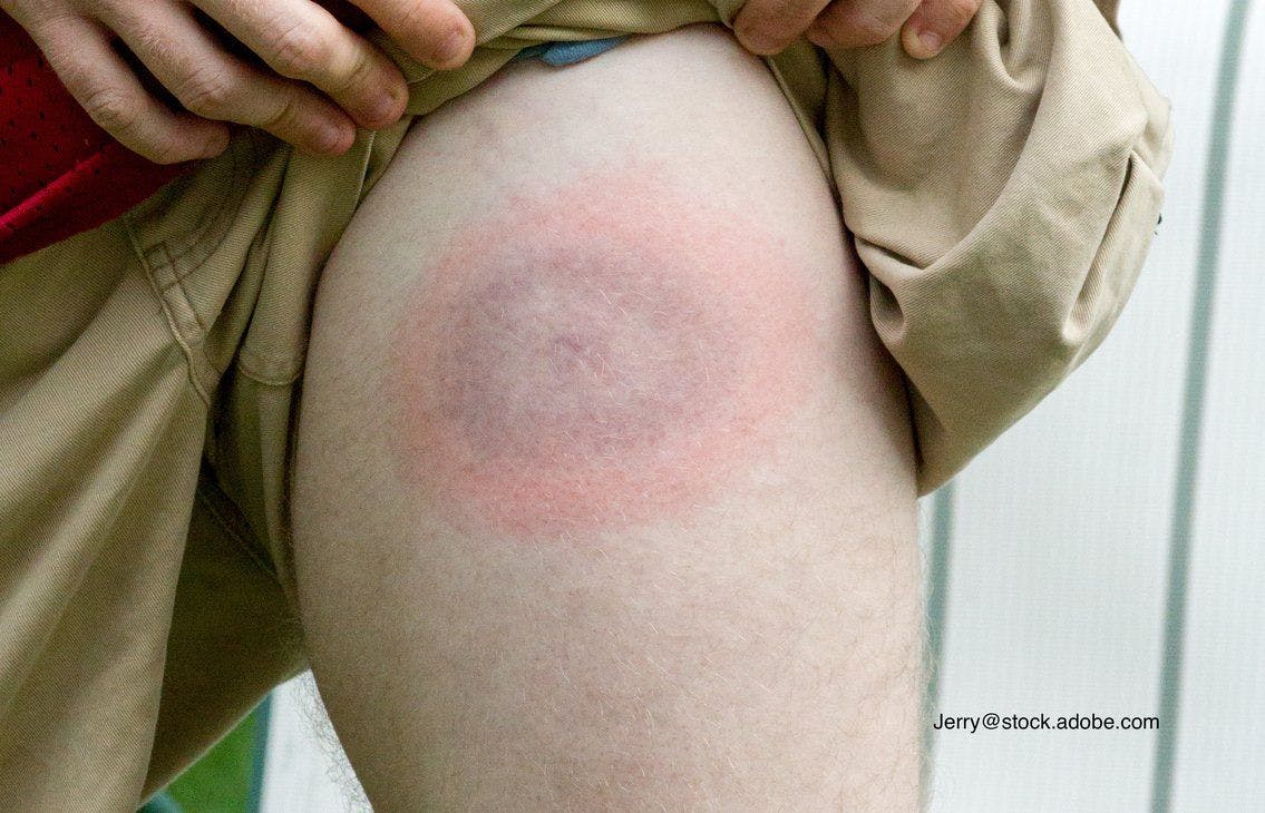 classic Lyme disease rash on leg