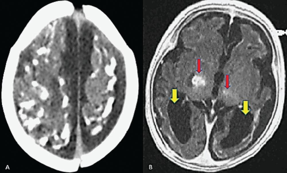 A. Axial cranial CT of case patient showing generalized cortical calcifications with dilation of bilateral lateral ventricles. B. Axial cranial MRI of case patient showing generalized parenchymal atrophy and dilation of the bilateral lateral ventricles (yellow arrows) with patent basal cisterns and coarse supratentorial calcifications involving the cortex (red arrows), basal ganglia bilaterally, and the vermis. No midline shift was noted.
