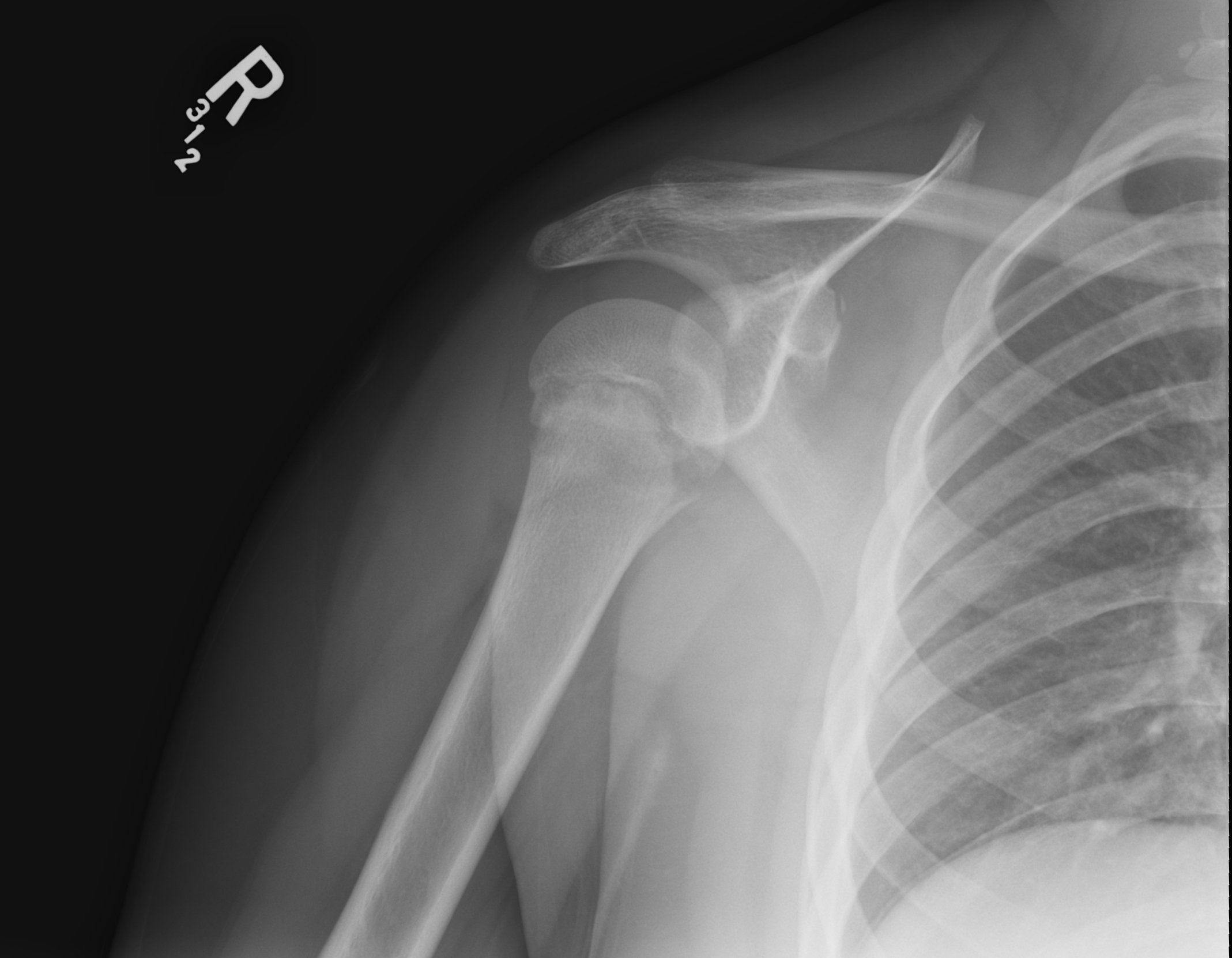 Shoulder x-ray - internal rotation view