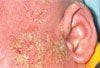 Atopic Dermatitis Superinfection Caused by Staphylococcus sciuri and Enterobacter asburiae