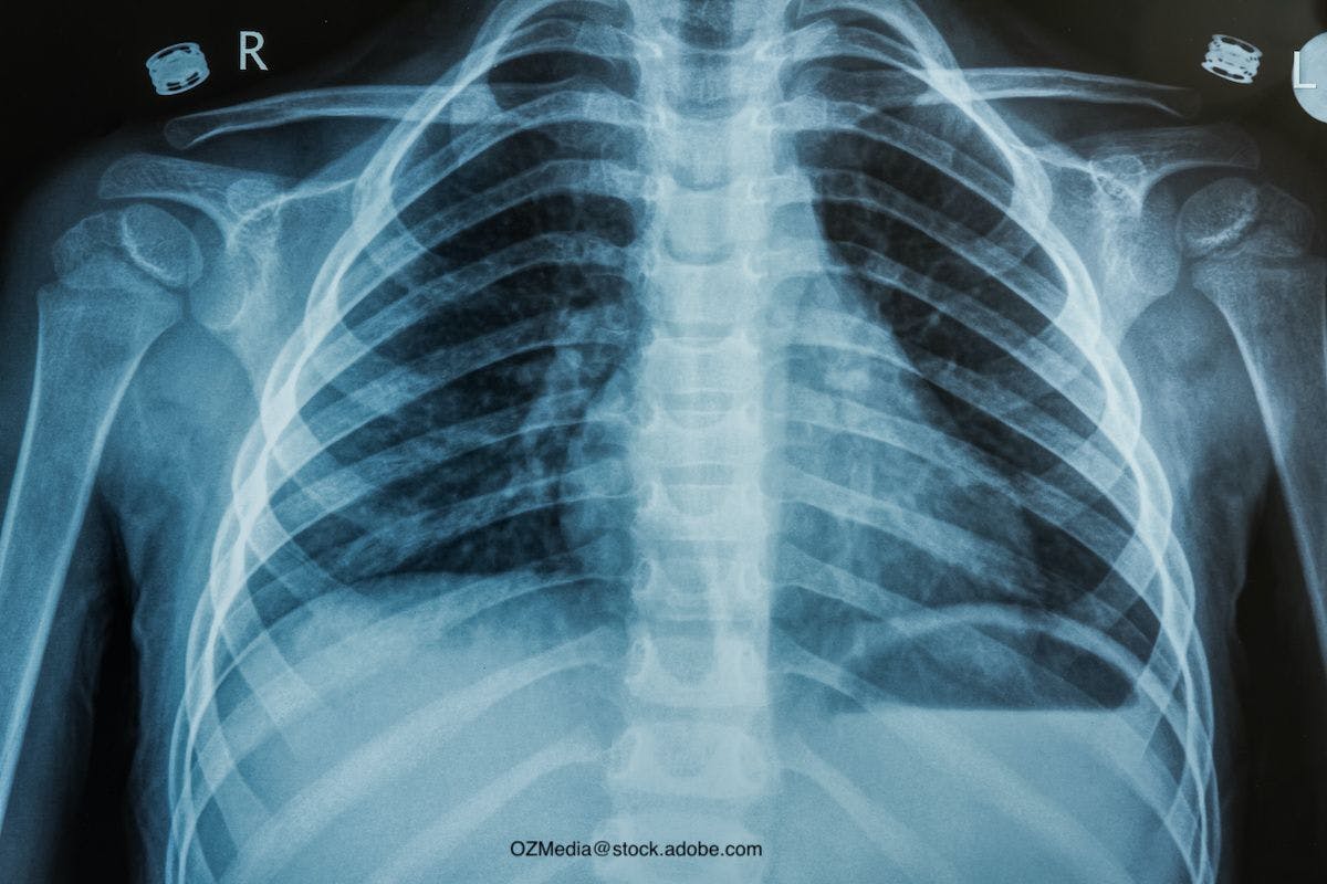 How to correctly diagnose and treat community-acquired pneumonia