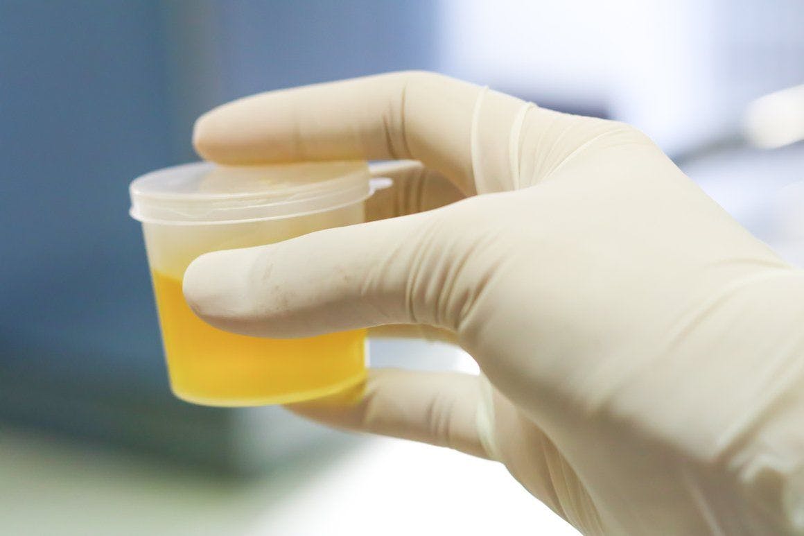 Urine drug screens: Caveats for interpreting results