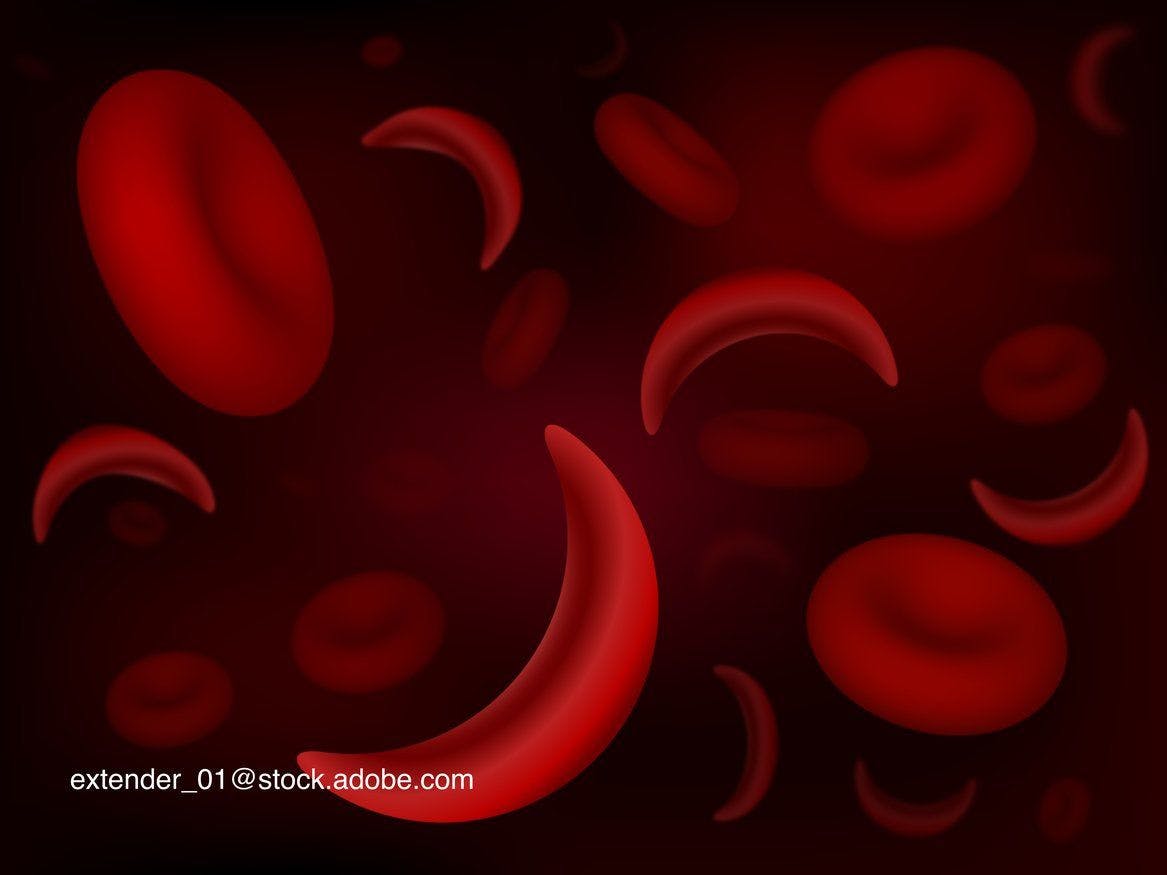 image of normal and sickle shaped blood cells
