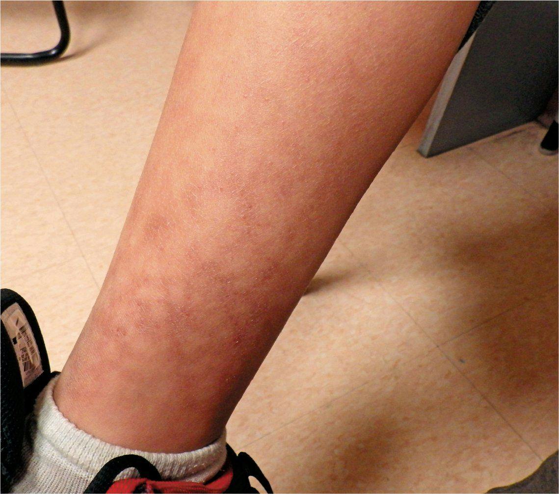 Patient presents with a persistent, nonblanching reticular rash on his lower extremities