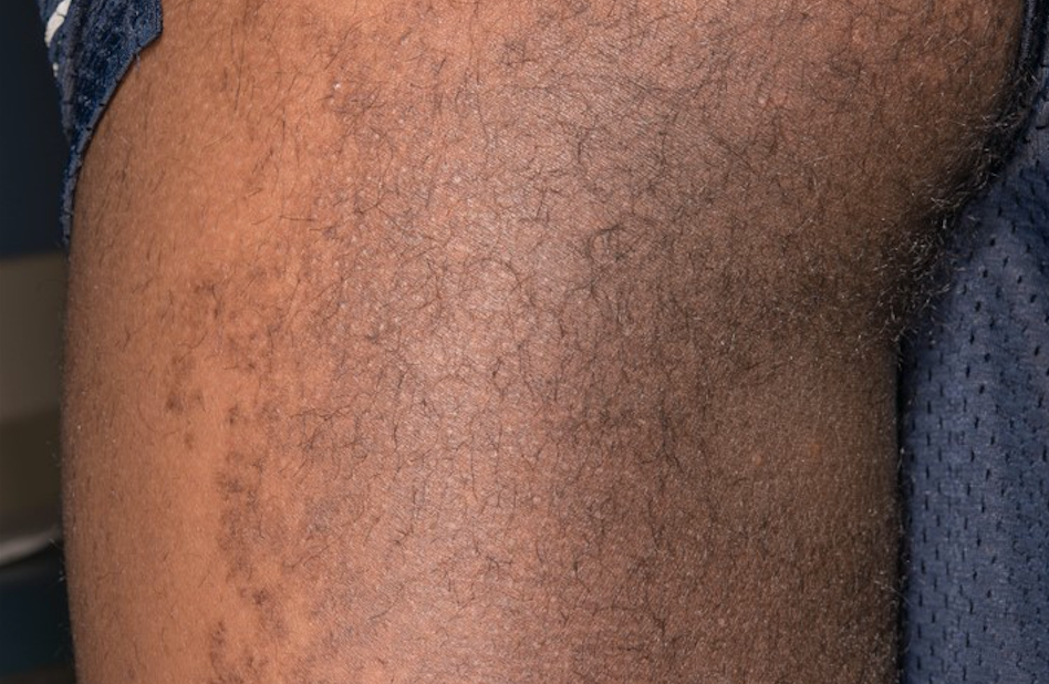 Teenage boy with asymptomatic brown plaque on back of thigh