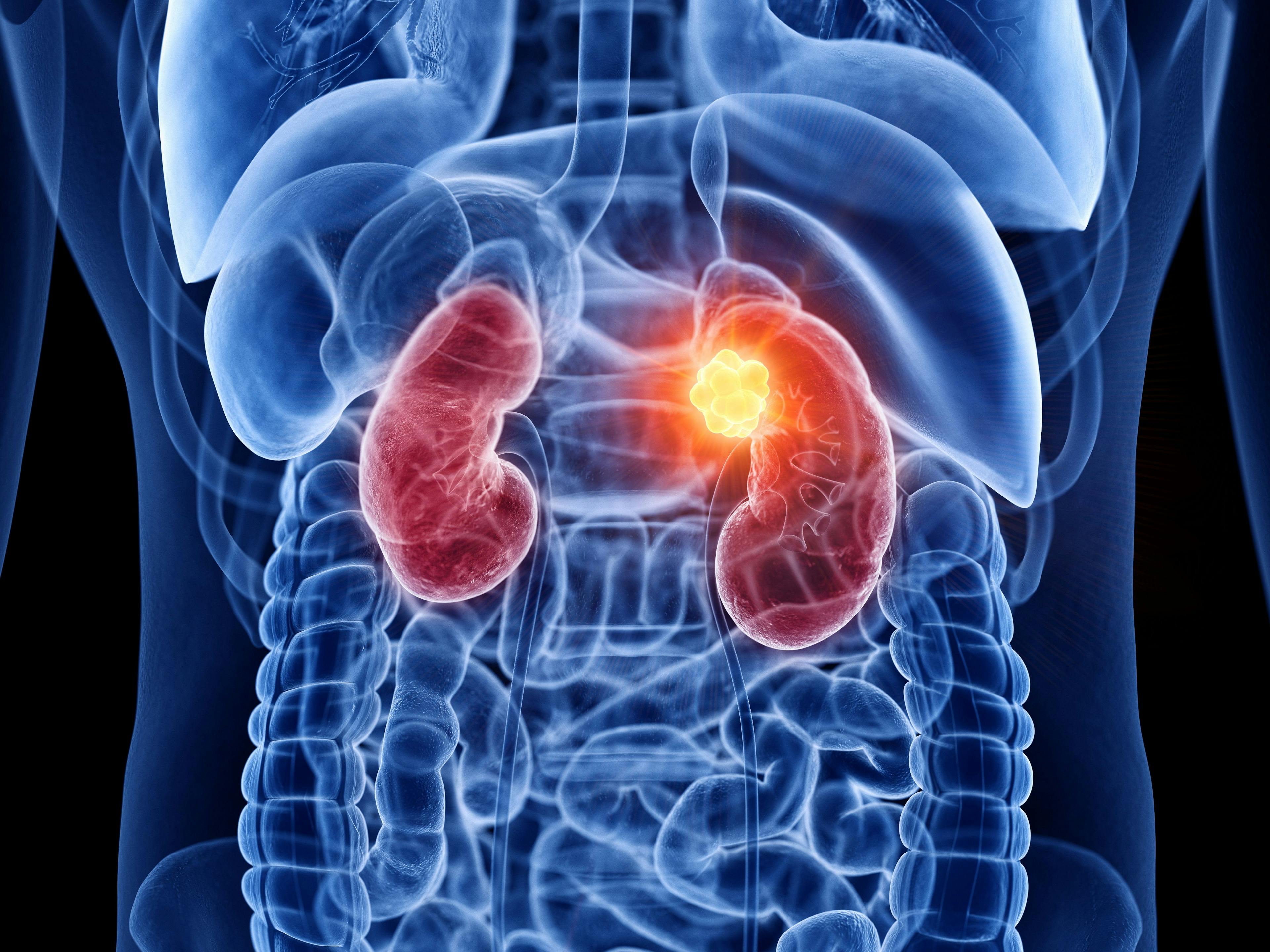 Inaxaplin to treat APOL1-mediated kidney disease moves to phase 3 trial | Image Credit: © Sebastian Kaulitzki - © Sebastian Kaulitzki - stock.adobe.com.