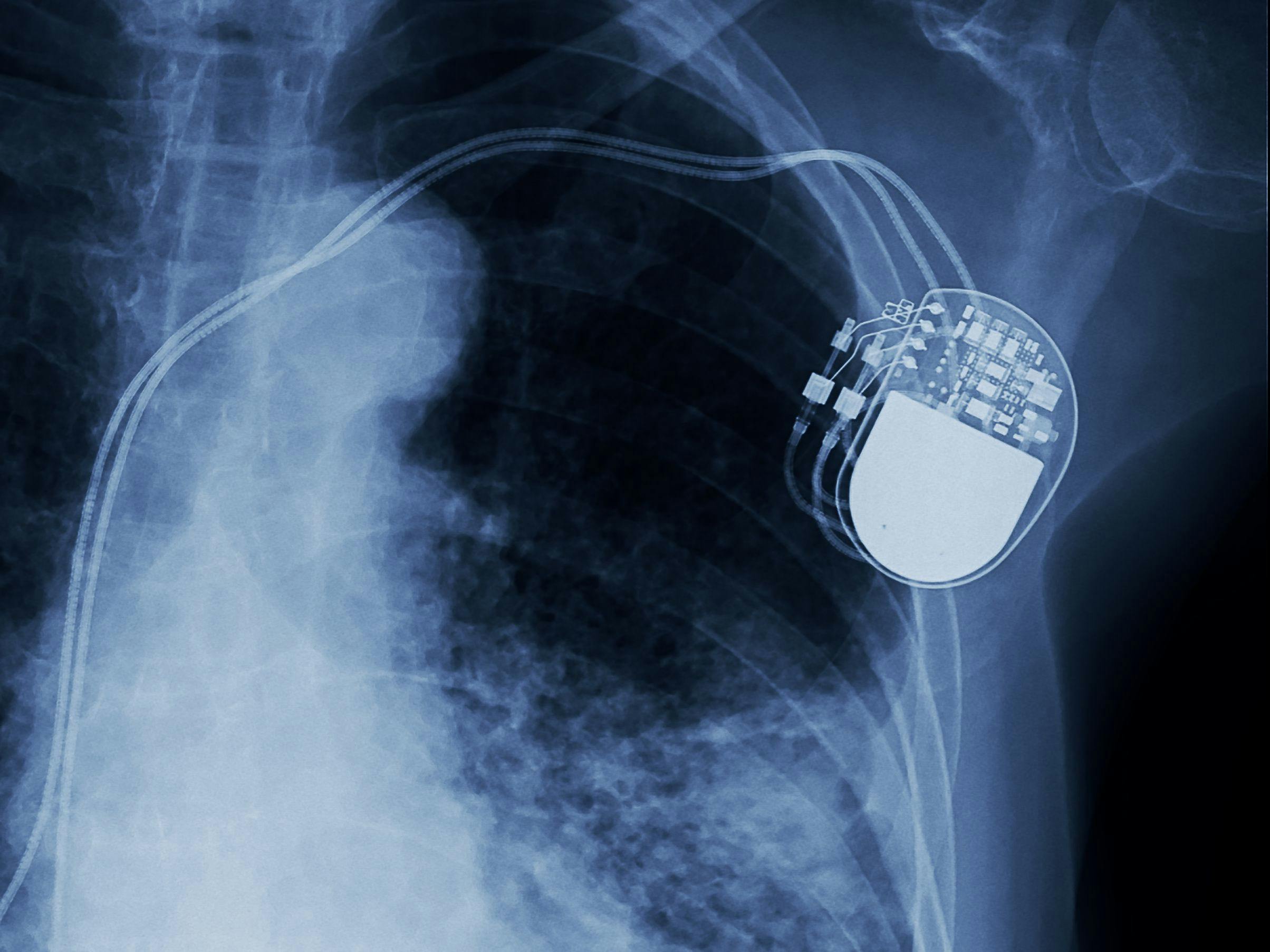 X-ray image of pacemaker | Image Credit: © Choo - © Choo - stock.adobe.com.