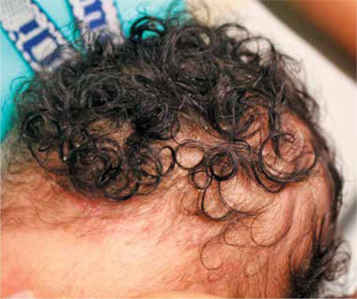 Asymptomatic, erythematous greasy scales distributed throughout patient's scalp