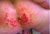 Jacquet's Dermatitis: An Unusual Type of Diaper Rash