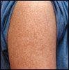 Teenager With Small Red Papules on Her Arms and Thighs
