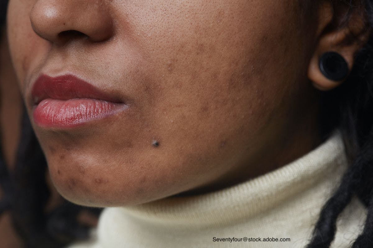 Examining the interaction of mental health, race, ethnicity, and acne