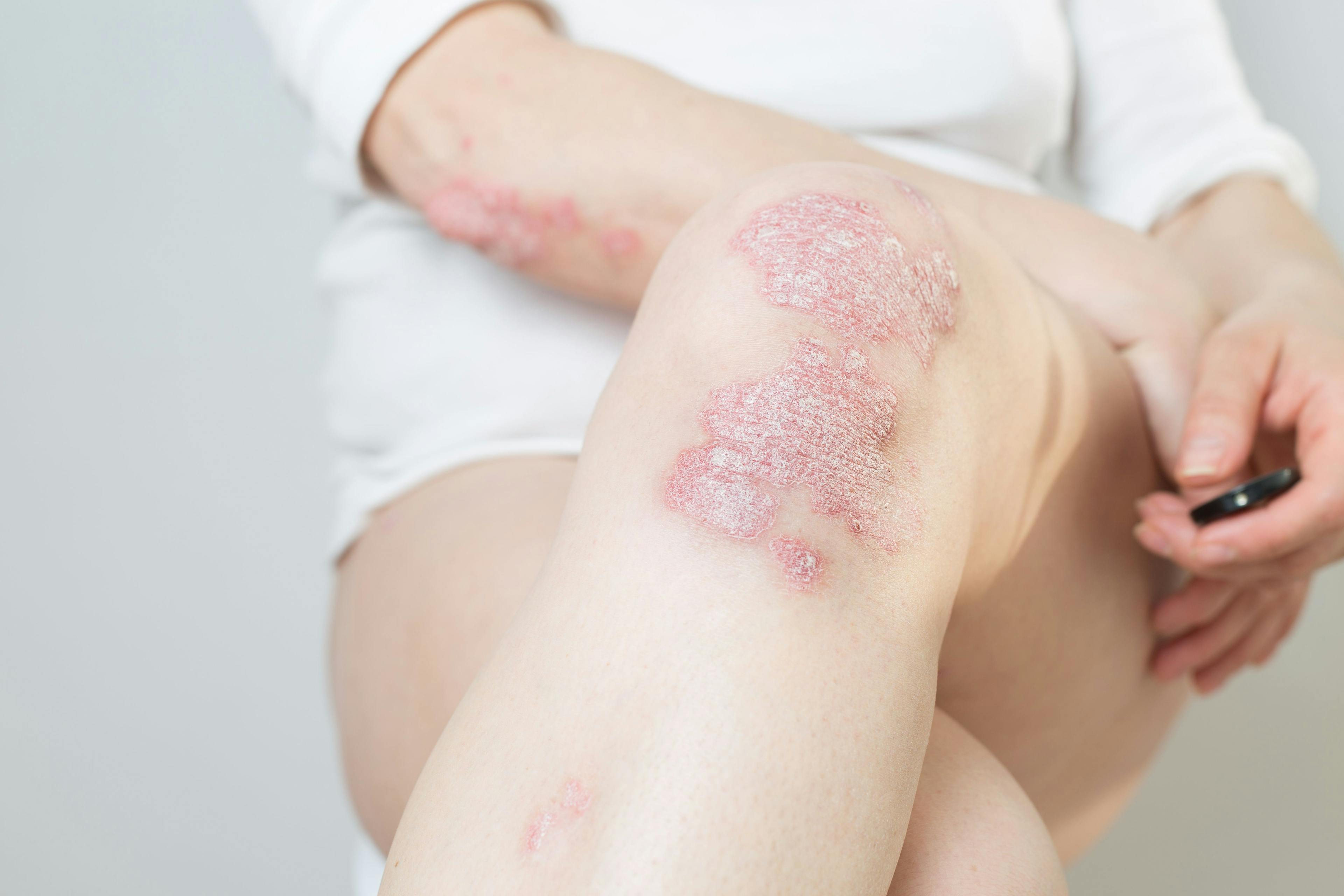 Arcutis submits roflumilast cream for treating plaque psoriasis in patients aged 2 to 11 years