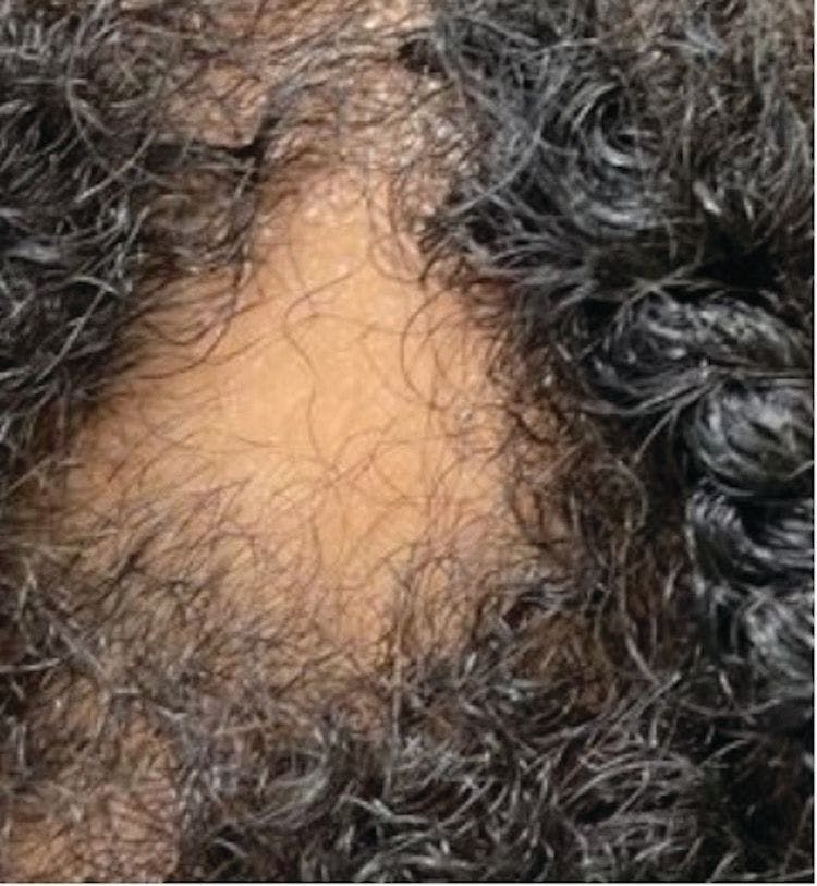 Figure 1. On the scalp, there is a smooth and well-demarcated patch of complete hair loss, representing alopecia areata.