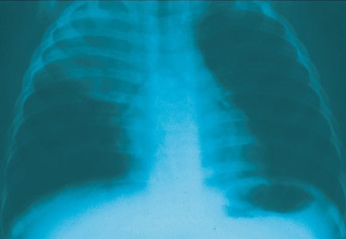 Take the “Breath Test”-A Pediatric Respiratory Photo Essay