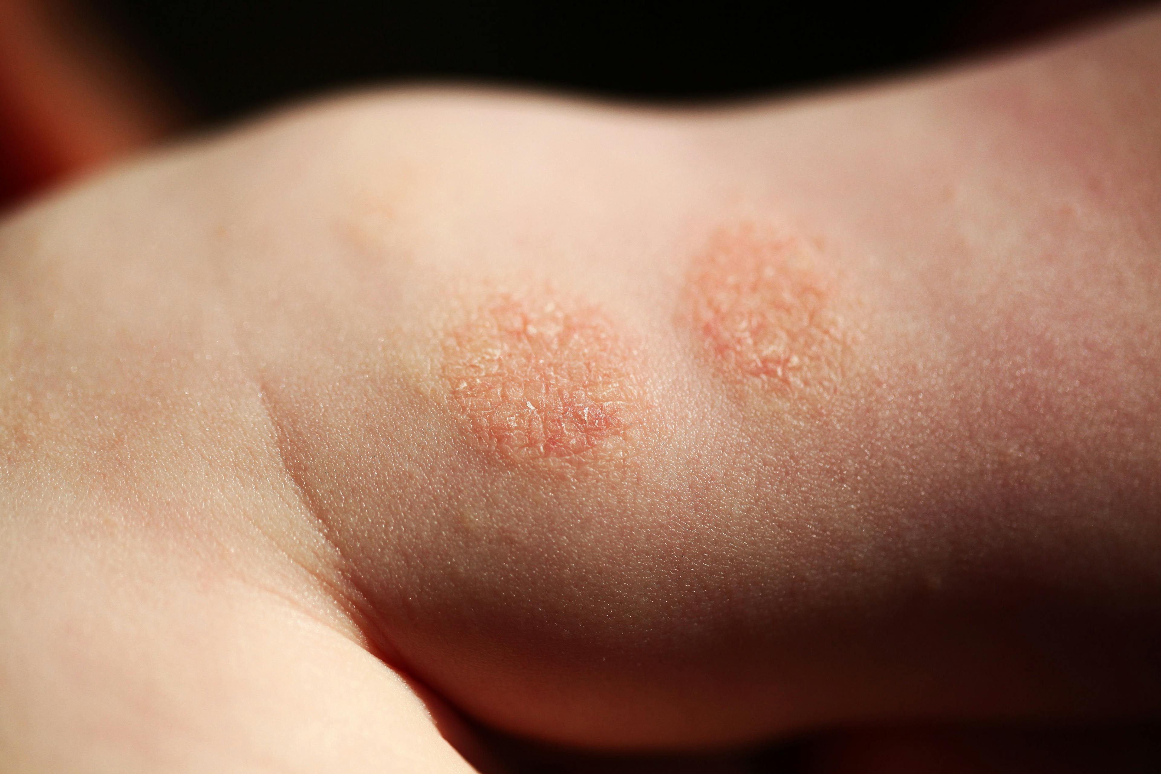 Review examines different ways to reduce costs for atopic dermatitis treatment