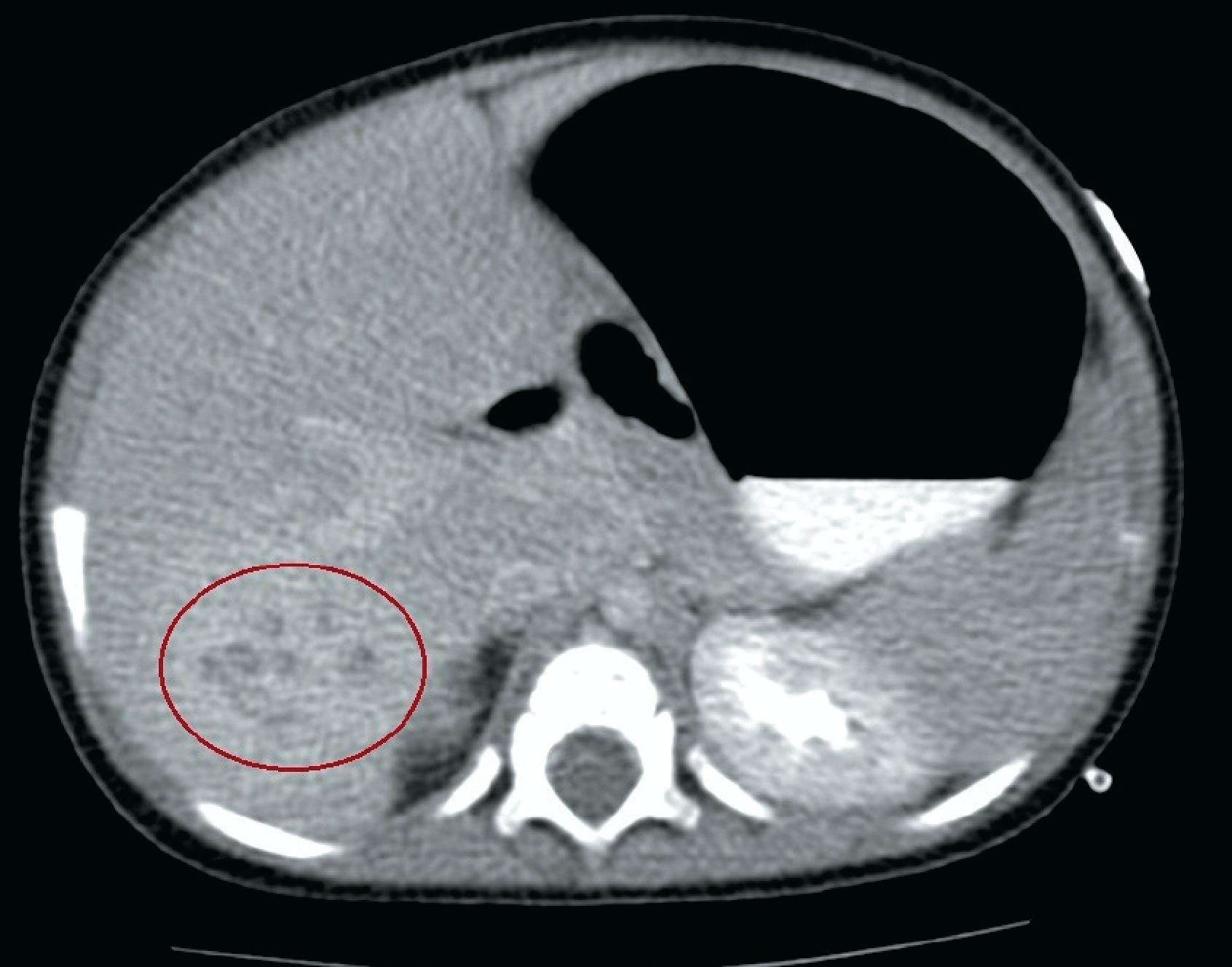 Infant with febrile neutropenia and a hepatic mass