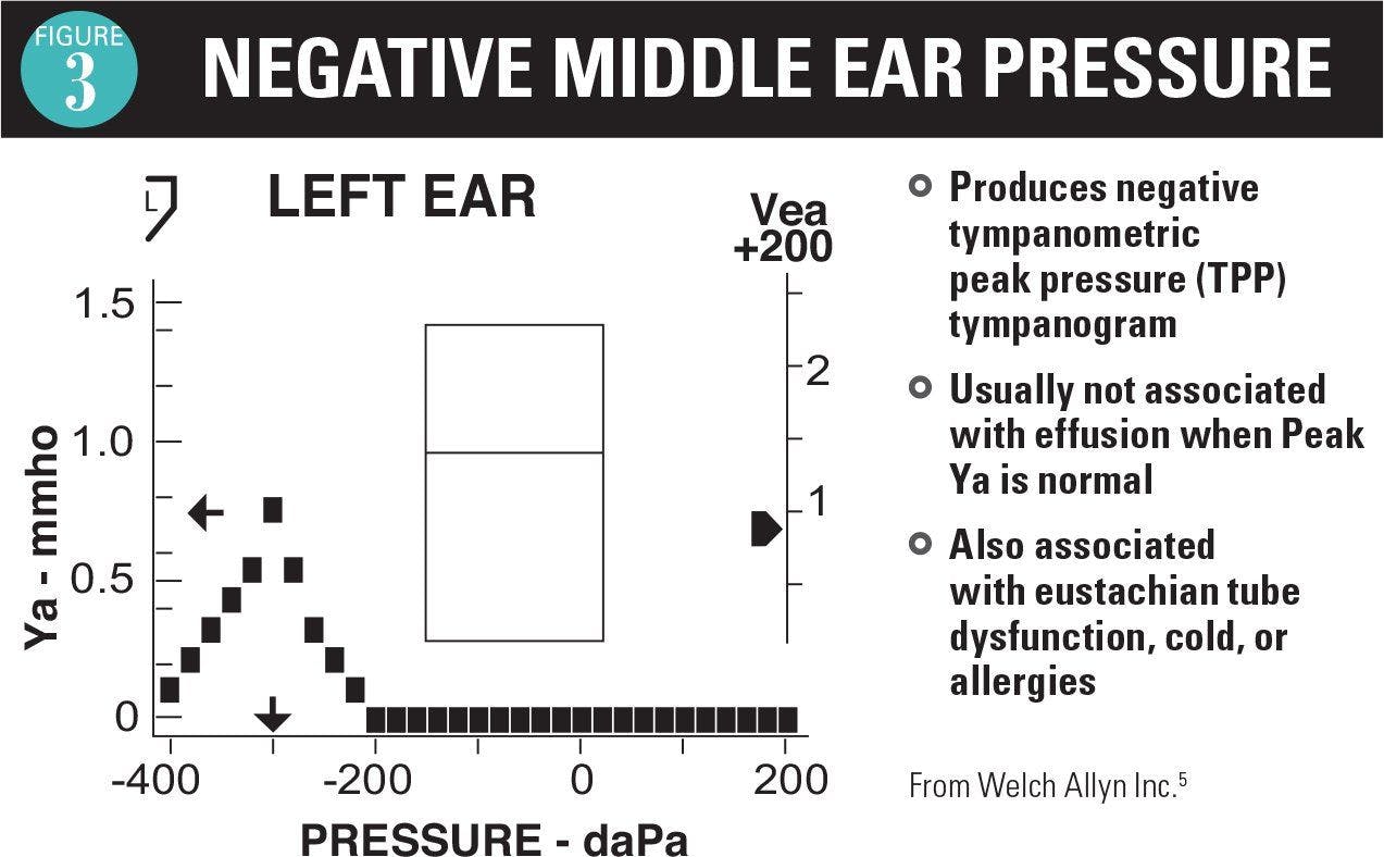 Negative middle ear pressure