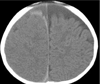 Intraparenchymal Hemorrhage: Child Abuse-or Mimic?