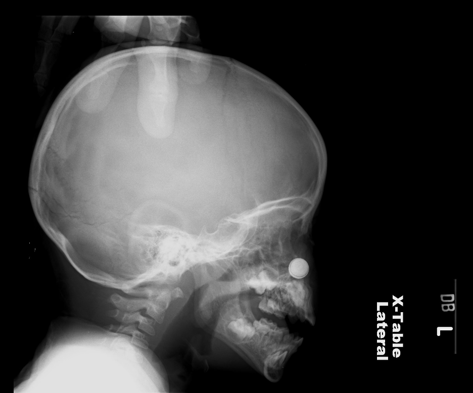 Figure 2: Head x-ray of 2-year-old boy