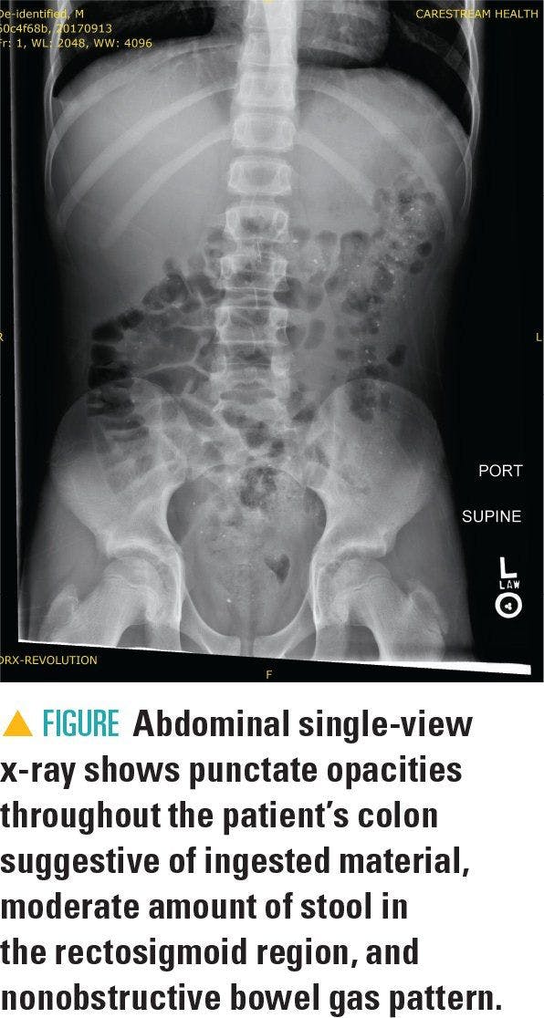 Abdominal single-view x-ray shows punctuate opacities throughout the patient's colon suggestive of ingested material, moderate amount of stool in the rectosigmoid region, and nonobstructive bowel gas pattern