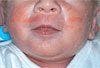 Photoclinic: Asymmetric Crying Facies Syndrome
