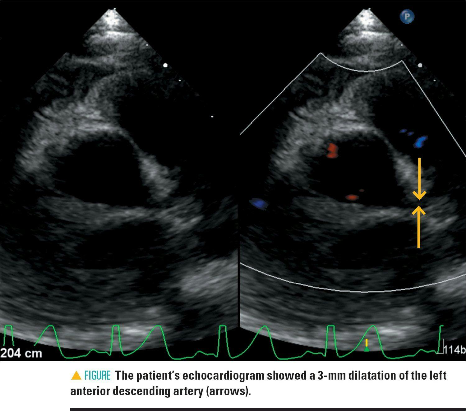 Patient's echocardiogram shows a 3-mm dilation of the left anterior descending artery