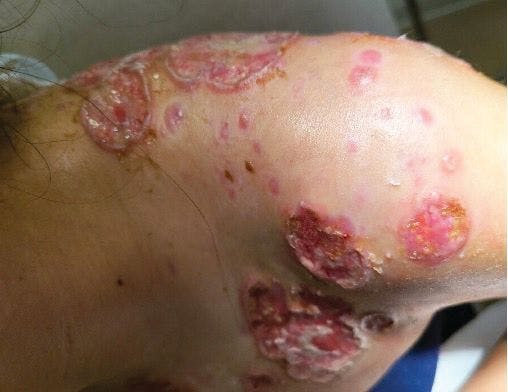 Figure 1. Note hemorrhagic, crusted nodulocystic lesions that have undergone extensive ulceration. (Image provided by author)
