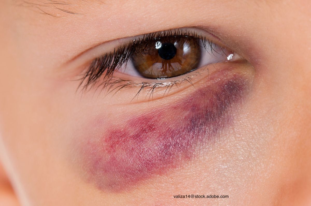 Understanding the factors that contribute to abusive head trauma in kids