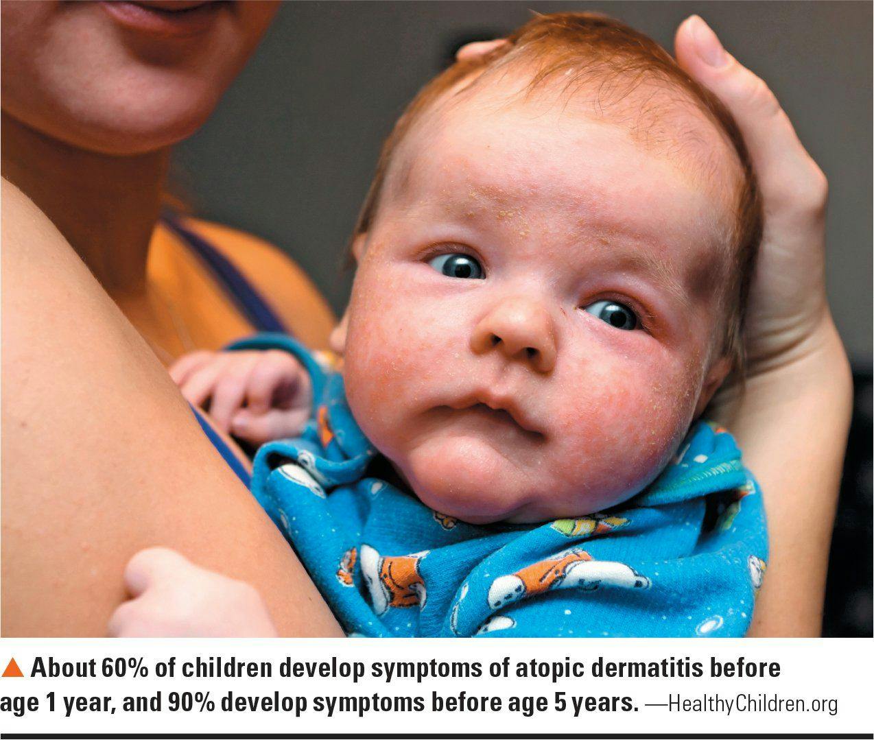 statistic about atopic dermatitis