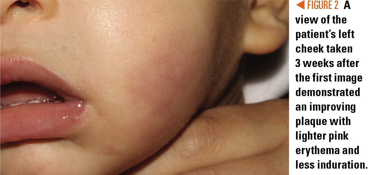 View of the patient's cheek 3 weeks later
