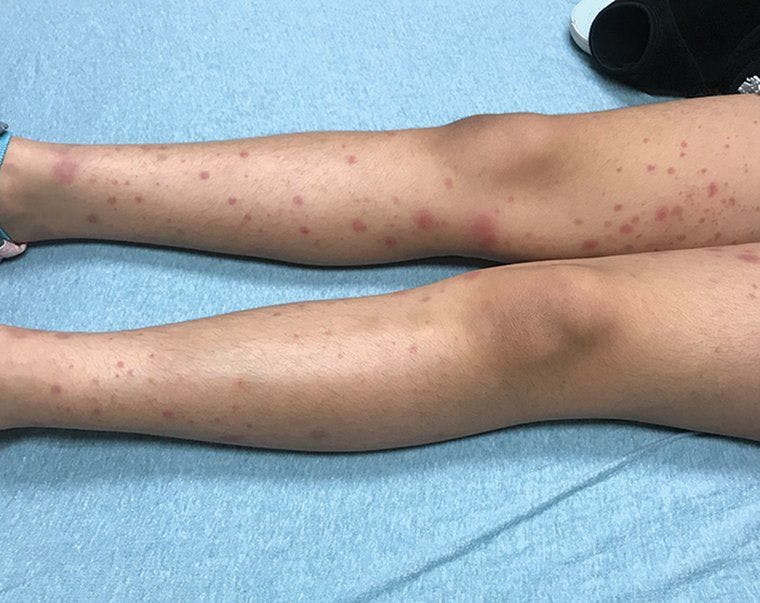 Palpable erythematous purpuric and macular rash extends over the extensor surface of the patient's bilateral lower extremities