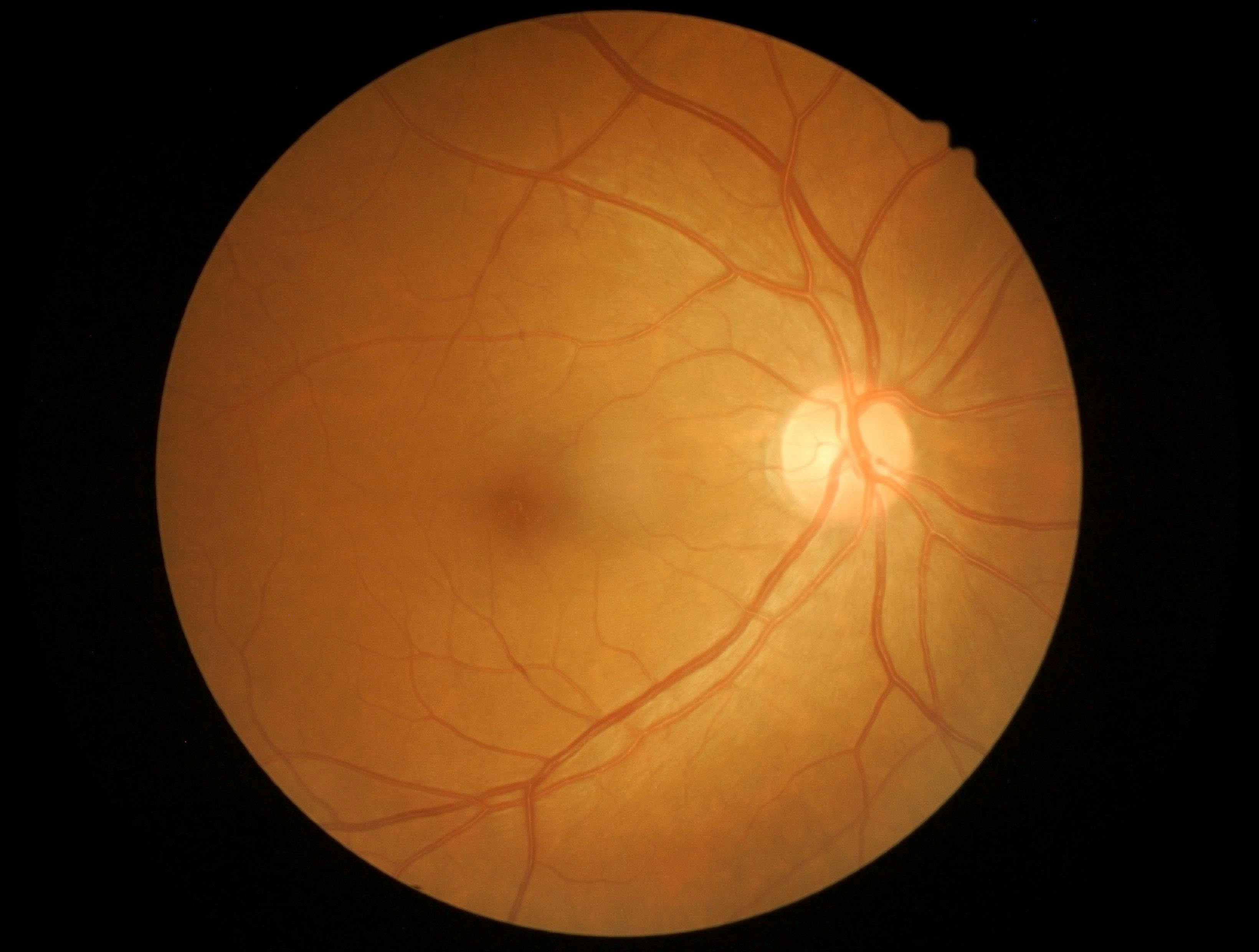 Infants with acute ROP remain at risk of vision-threatening outcomes in later life