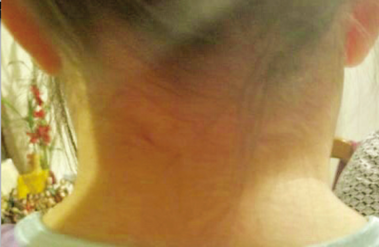 image of 8-year-old girl with swelling on right side of neck