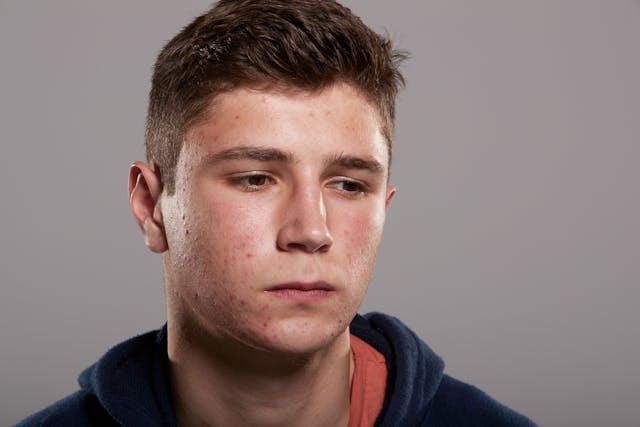 Teenager with acne | Image Credit: © Monkey Business - © Monkey Business - stock.adobe.com.