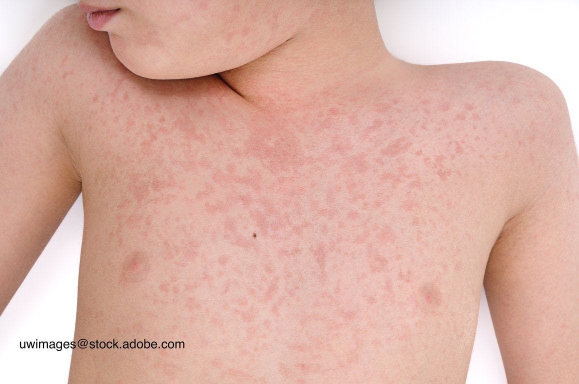 Ohio makes 29 states with measles