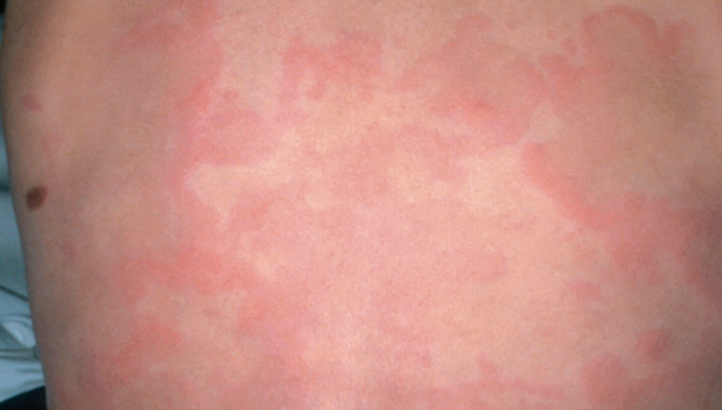 Persistent pruritic rash in an 8-year-old boy